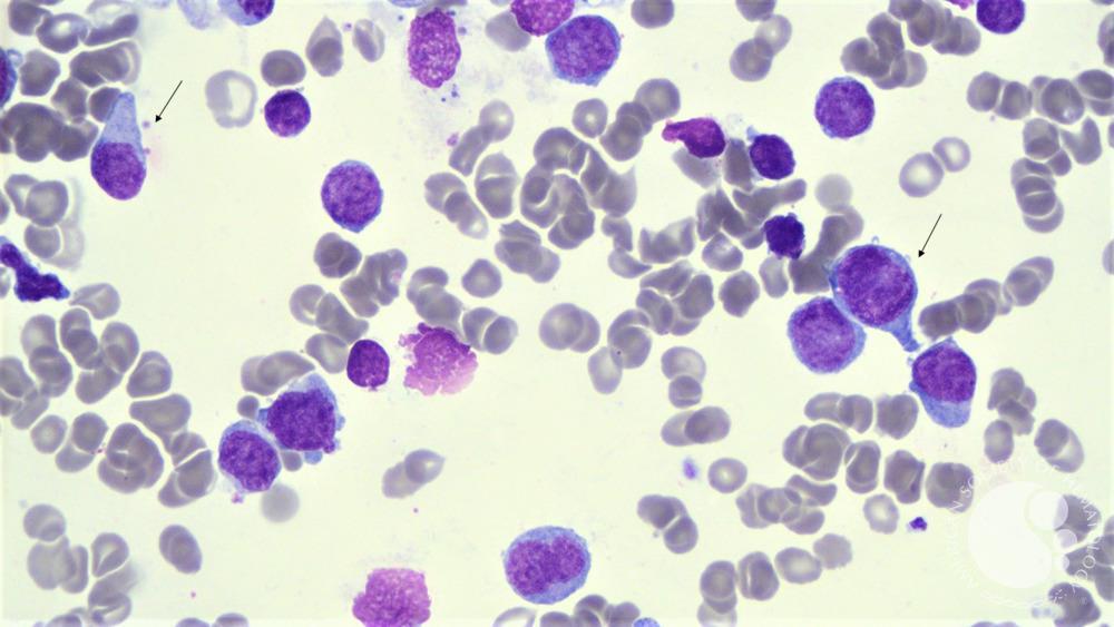 T-cell acute lymphoblastic leukemia