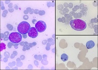 Acute Myeloid Leukemia with t(8;21)(q22;q22)