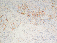 Littoral cell angioma- CD21