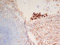 Littoral cell angioma- CD68