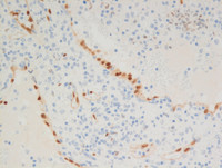 Littoral cell angioma- ERG