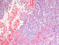 Littoral cell angioma- HE