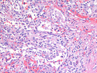 Littoral cell angioma- HE