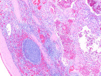 Littoral cell angioma- HE