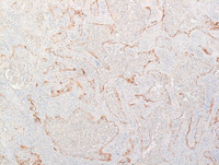 Littoral cell angioma- Langerin