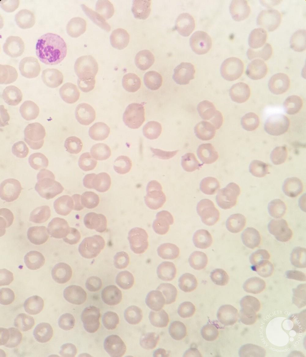 Typical RBC morphology in Sickle β Thalassemia 1