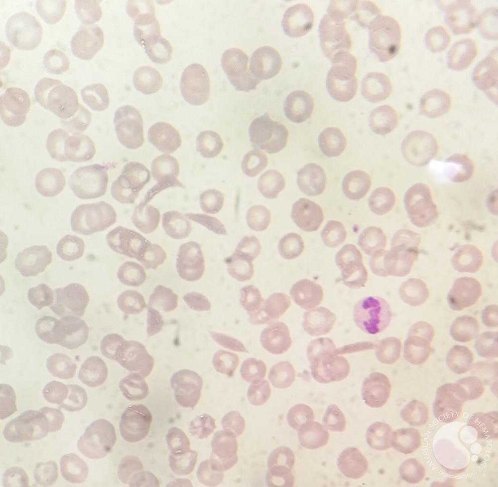Typical RBC morphology in Sickle β Thalassemia 2