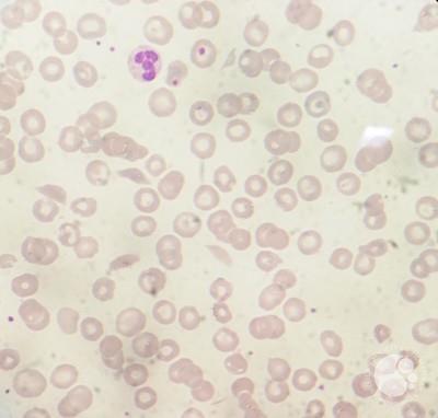 Typical RBC morphology in Sickle β Thalassemia 3