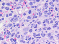 Transformed Follicular lymphoma-Bone marrow biopsy H&E