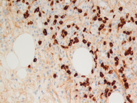 Extranodal Rosai-Dorfman disease- IgG4