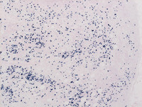Extranodal Rosai-Dorfman disease- Lambda