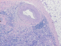 Extranodal Rosai-Dorfman disease- H&E