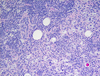 Extranodal Rosai-Dorfman disease- H&E