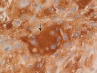 Extranodal Rosai-Dorfman disease- S-100