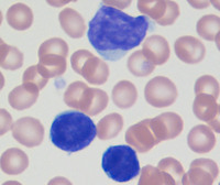 Sezary syndrome-Peripheral blood smear