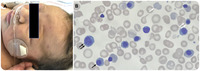 Jaundice  Pyruvate Kinase Deficiency