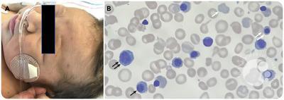 Pyruvate kinase deficiency in a newborn with extramedullary hematopoiesis in the skin