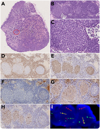 Early pattern of large B-cell lymphoma with IRF4 rearrangement