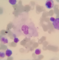 Presence of histiocytes in normal bone marrow aspirate sample 3