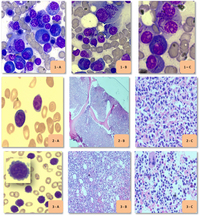 Morphological variants of plasma cell myeloma cases 13