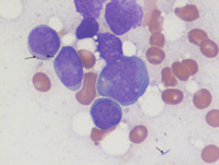 AML Wright-Giemsa stained aspirate