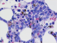 AML Bone marrow core biopsy with H & E stain