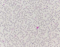 Severe RBC anisopoikilocytosis