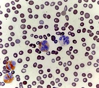 Myeloperoxidase negative dysplastic neutrophil