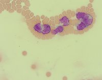 Peripheral Smear 1