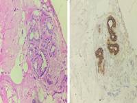 NON NEOPLASTIC GLANDS IN BONE MARROW TREPHINE BIOPSY 2