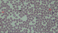 South-East Asian Ovalocytosis 1