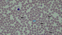 South-East Asian Ovalocytosis 2