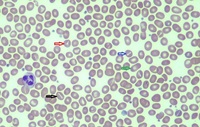 South-East Asian Ovalocytosis 3