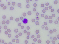 Figure 01: Peripheral smear showing vacuolated lymphocytes(x1000)