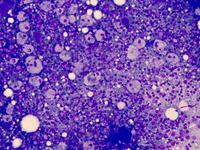 Figure 02: Bone marrow aspirate showing numerous macrophages with abundant vacuolated cytoplasm (x200)