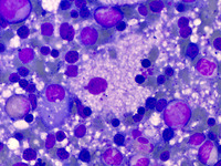 Figure 03: Bone marrow aspirate showing macrophage with abundant vacuolated cytoplasm (x1000)