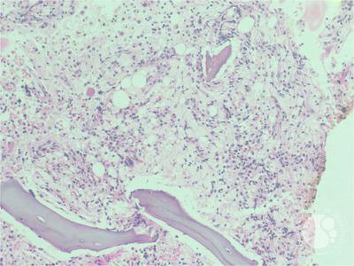 Figure 04: Bone marrow trephine biopsy showing focal interstitial aggregates and singly dispersed large polygonal cells(x400)