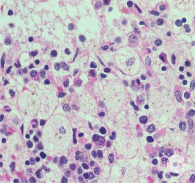 Figure 05: Trephine biopsy showing foamy macrophages with abundant finely vacuolated foamy cytoplasm and small, round centrally placed nuclei (x1000)