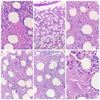 Bone marrow biopsy involvement by amyloidosis 1