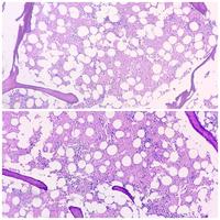 Bone marrow biopsy involvement by amyloidosis 2