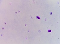 Thick smear Plasmodium vivax