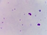 Thick blood film Plasmodium vivax