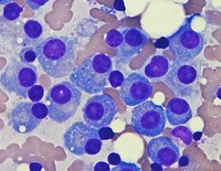 Multiple myeloma - Bone marrow smear 2