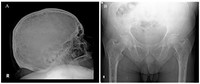 Multiple myeloma - Radiographs
