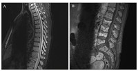 Multiple Myeloma Mri 