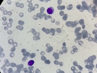 Hairy cell leukaemia 1