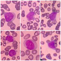 Leukemia cutis in acute myeloid leukemia - 2