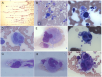 Megakaryocytes and micromegakaryocytes in peripheral blood of a patient with acute myeloid leukemia