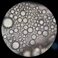 Fat embolism syndrome (COVID-19) - Figure 3