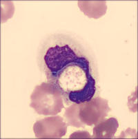 Fat embolism syndrome (COVID-19) - Figure 4